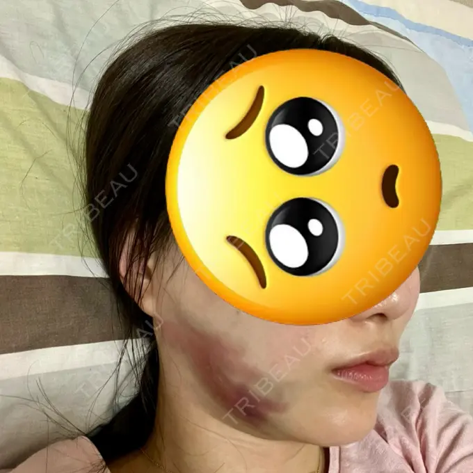 糸リフト / 脂肪吸引（顔） / ジョールファット除去 RIVER CLINIC（リバークリニック） DAY 1 メイン用