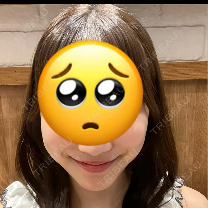 糸リフト / 脂肪吸引（顔） / ジョールファット除去 RIVER CLINIC（リバークリニック） DAY 13 メイン用