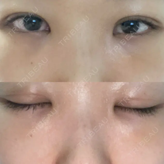 二重埋没 / クマ治療 / ボトックス（エラ・小顔） / ヒアルロン酸注入（額） / ボトックス（肩） / その他（目元） TCB東京中央美容外科 京都四条院 DAY 18 メイン用