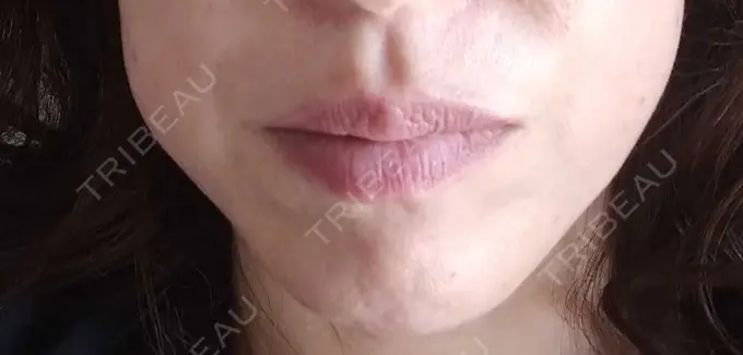 ボトックス（エラ・小顔） TCB東京中央美容外科 金山院 DAY 33 メイン用