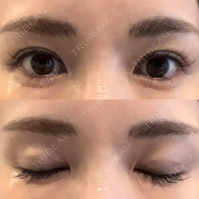 二重埋没 吉祥寺アイビークリニック DAY 12 メイン用