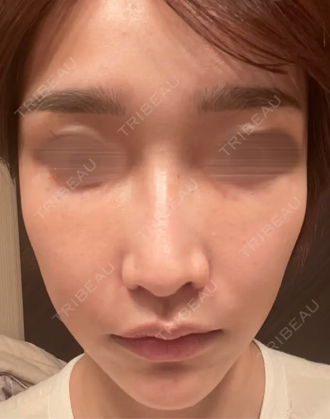 ピコスポット お肌のクリニック　高田馬場 DAY 63 メイン用