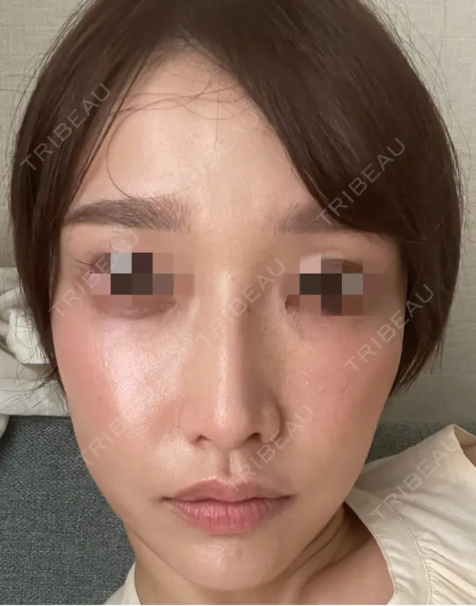 ピコスポット お肌のクリニック　高田馬場 DAY 64 メイン用