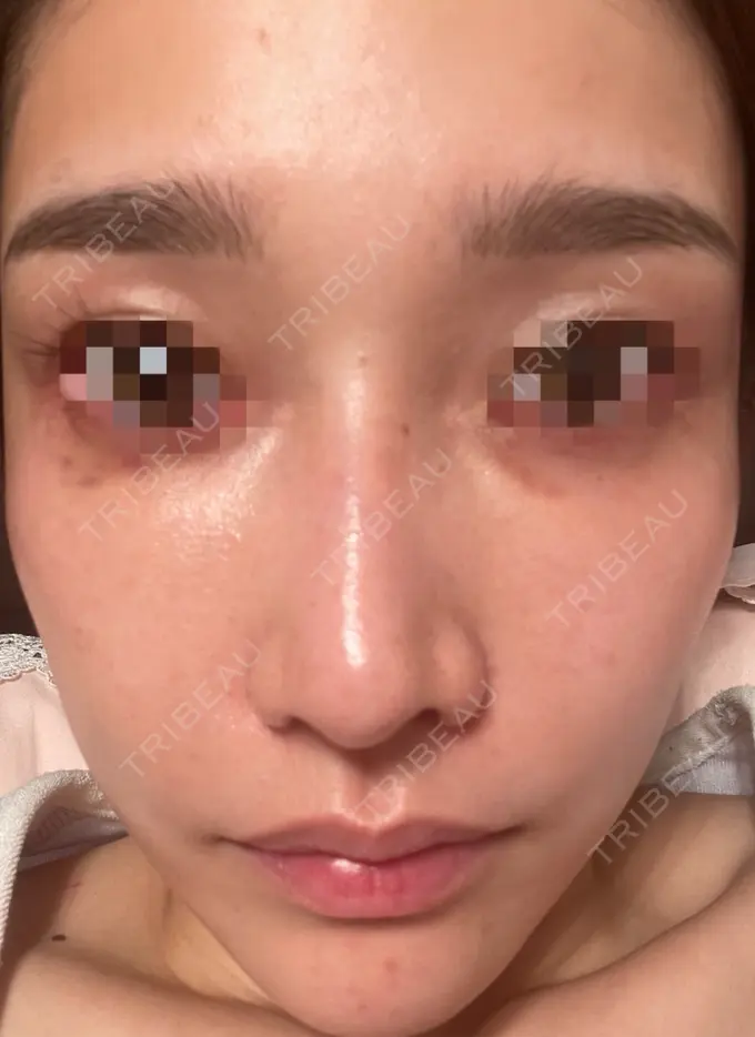 ピコスポット お肌のクリニック　高田馬場 DAY 65 メイン用