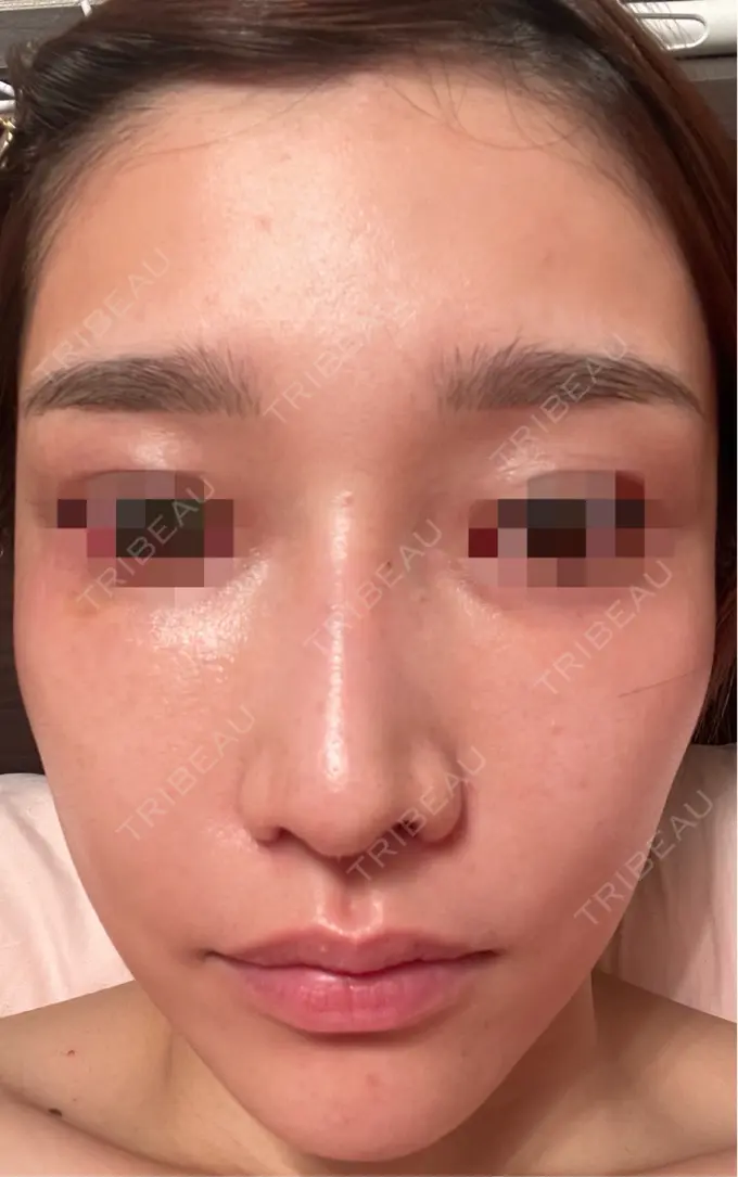 ピコスポット お肌のクリニック　高田馬場 DAY 67 メイン用