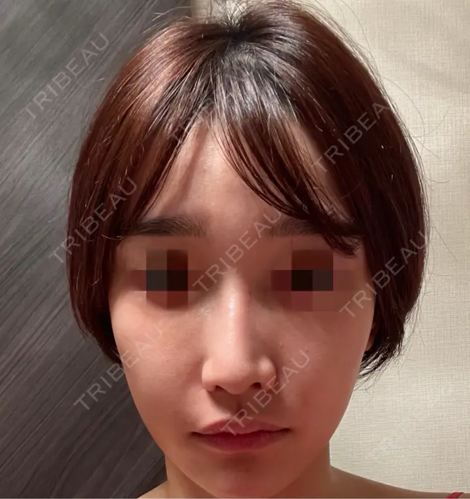 ピコスポット お肌のクリニック　高田馬場 DAY 69 メイン用