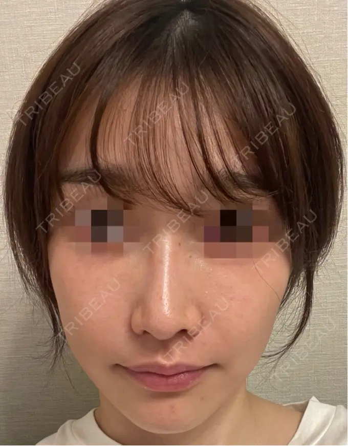 ピコスポット お肌のクリニック　高田馬場 DAY 71 メイン用