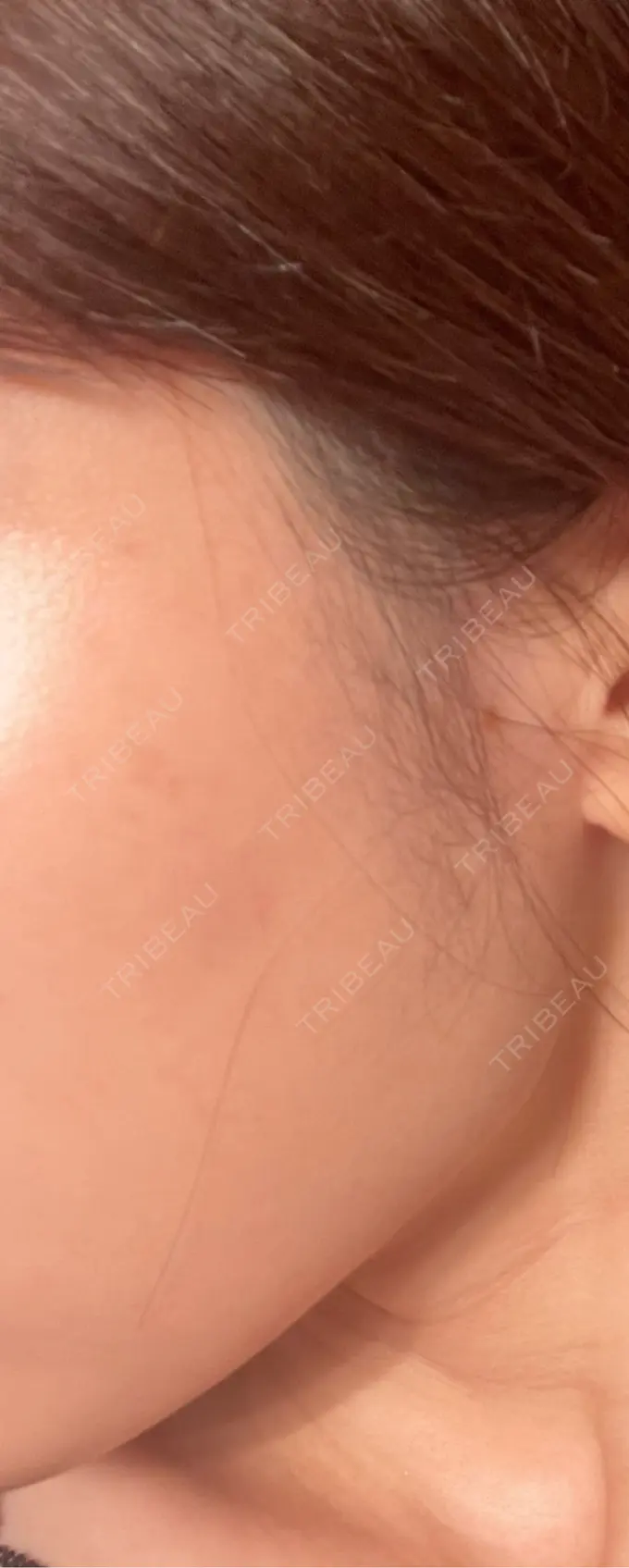 ピコスポット お肌のクリニック　高田馬場 AFTER メイン用