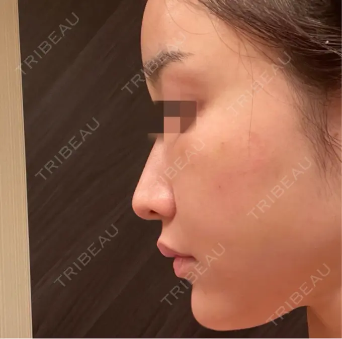 ピコスポット お肌のクリニック　高田馬場 DAY 85 メイン用