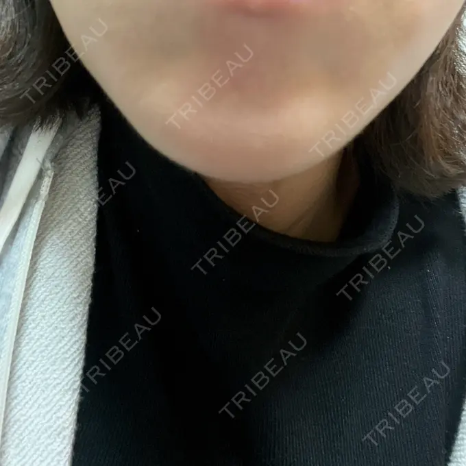 ボトックス（エラ・小顔） / ボトックス（眉間） / ボトックス（目尻） 湘南美容クリニック 名古屋栄院 AFTER メイン用