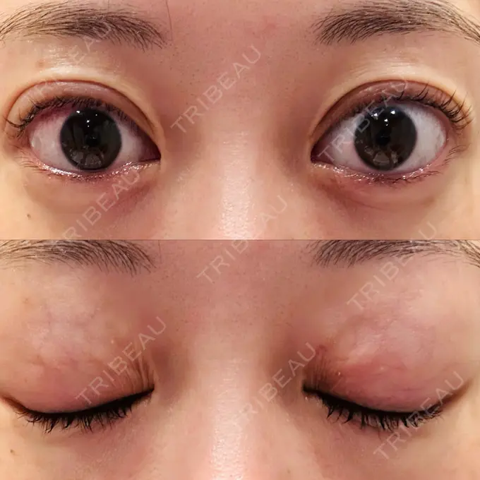 二重埋没 水の森美容クリニック 大阪梅田院 DAY 10 メイン用