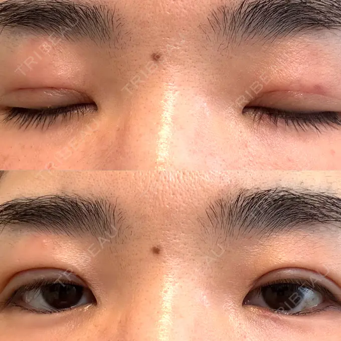 二重埋没 水の森美容クリニック 大阪梅田院 DAY 2 メイン用