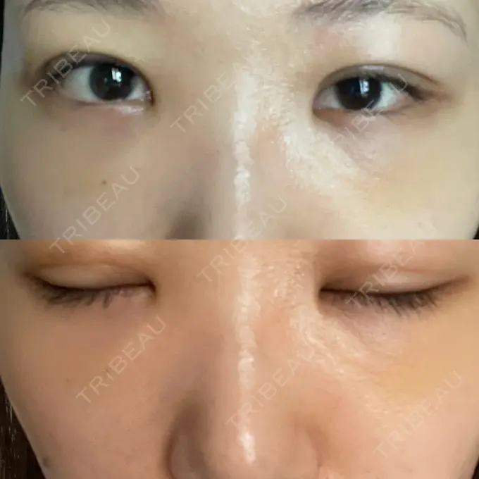 二重埋没 / クマ治療 / ボトックス（エラ・小顔） / ヒアルロン酸注入（額） / ボトックス（肩） / その他（目元） TCB東京中央美容外科 京都四条院 DAY 19 メイン用