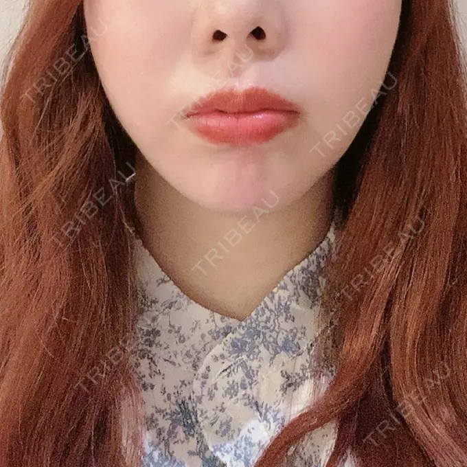 インディバ（顔） WOM SALON【術後ケア取扱いサロン】 DAY 0 メイン用