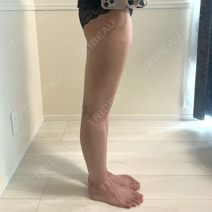 脂肪吸引（脚） Mods Clinic（モッズクリニック） 名古屋院 DAY 31 メイン用