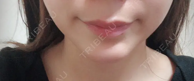 あごプロテーゼ ジュエリー美容外科 DAY 21 メイン用