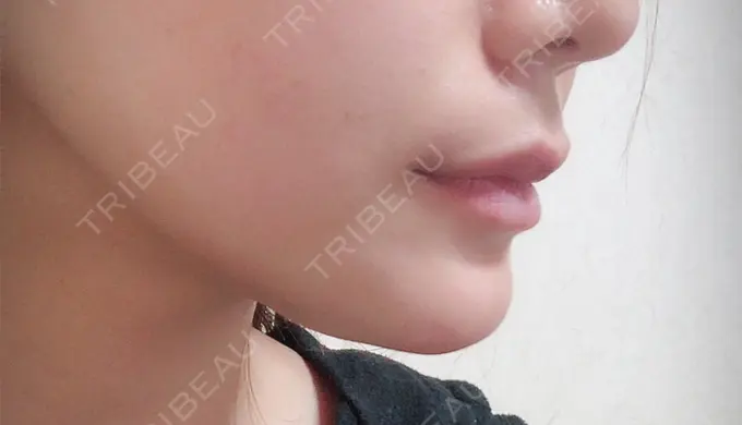 あごプロテーゼ ジュエリー美容外科 DAY 21 メイン用