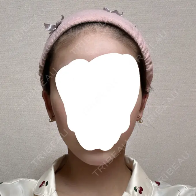 脂肪吸引（顔） Mods Clinic（モッズクリニック） 名古屋院 AFTER メイン用