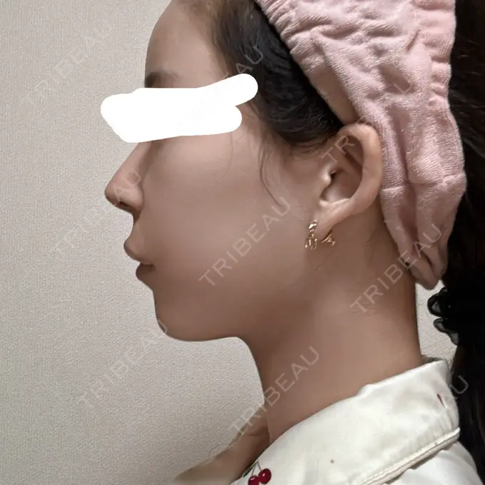 脂肪吸引（顔） Mods Clinic（モッズクリニック） 名古屋院 DAY 181 メイン用