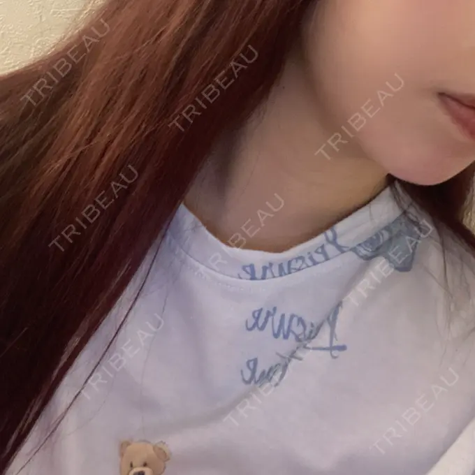 インディバ（顔） WOM SALON【術後ケア取扱いサロン】 AFTER メイン用