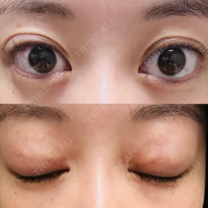 二重埋没 水の森美容クリニック 大阪梅田院 DAY 11 メイン用