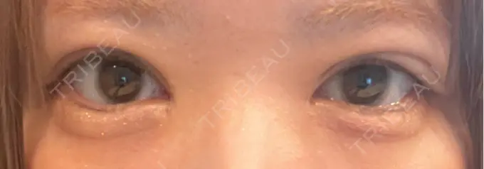 二重埋没 東京シンデレラ美容外科 大宮院 DAY 17 メイン用