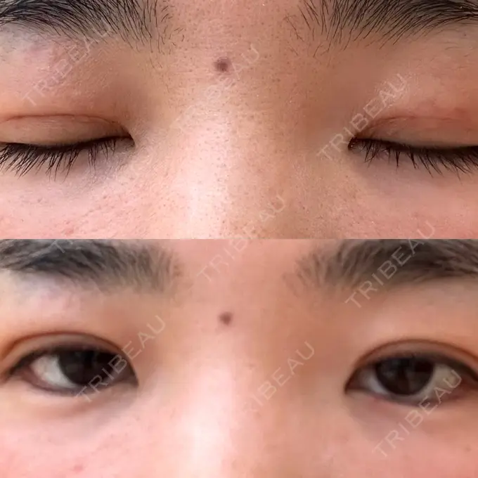 二重埋没 水の森美容クリニック 大阪梅田院 DAY 3 メイン用