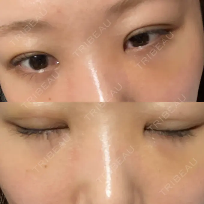 二重埋没 / クマ治療 / ボトックス（エラ・小顔） / ヒアルロン酸注入（額） / ボトックス（肩） / その他（目元） TCB東京中央美容外科 京都四条院 DAY 20 メイン用