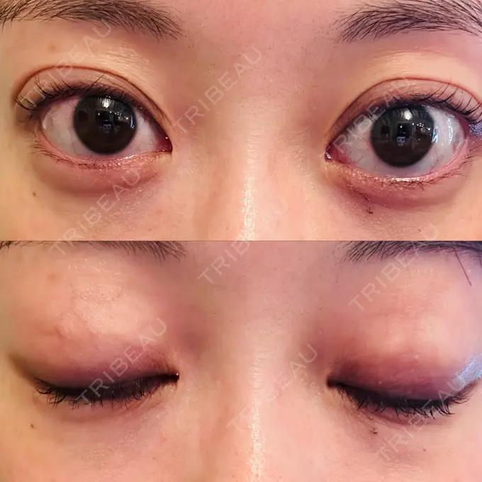 二重埋没 水の森美容クリニック 大阪梅田院 DAY 12 メイン用