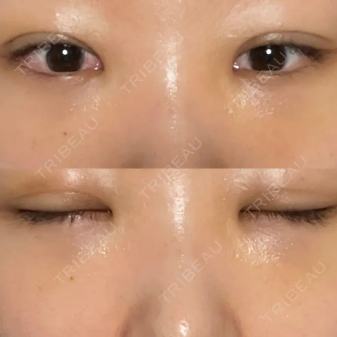 二重埋没 / クマ治療 / ボトックス（エラ・小顔） / ヒアルロン酸注入（額） / ボトックス（肩） / その他（目元） TCB東京中央美容外科 京都四条院 DAY 21 メイン用