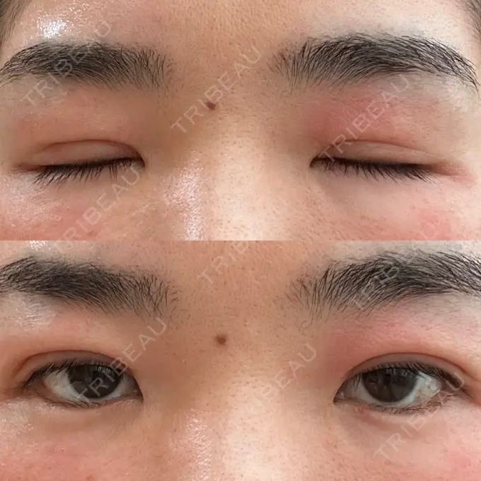 二重埋没 水の森美容クリニック 大阪梅田院 DAY 4 メイン用