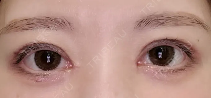 二重埋没 / 目頭切開 / クマ治療 ROOTS Clinic DAY 20 メイン用