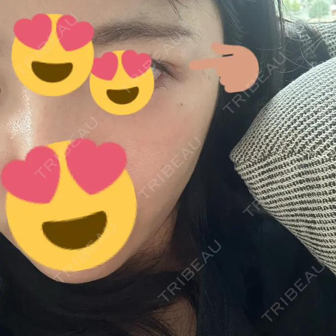 糸リフト / 脂肪吸引（顔） / 脂肪吸引（二の腕） / 上まぶたたるみ取り / 上まぶたの脂肪取り / ジョールファット除去 / 脂肪吸引（肩） / ボトックス（エラ・小顔） 湘南美容クリニック 秋葉原院 DAY 91 メイン用