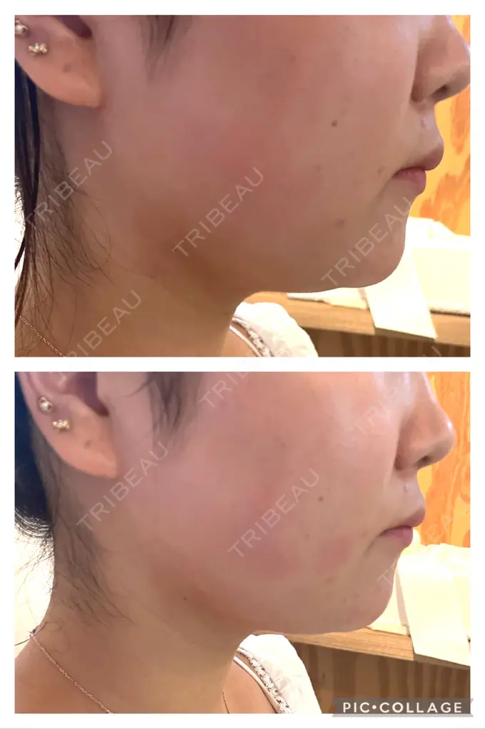 脂肪溶解注射（顔） 麻布十番クレールデンタルクリニック AFTER メイン用