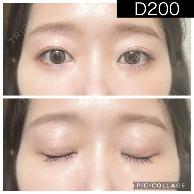 二重埋没 湘南美容クリニック 町田院 DAY 200 メイン用