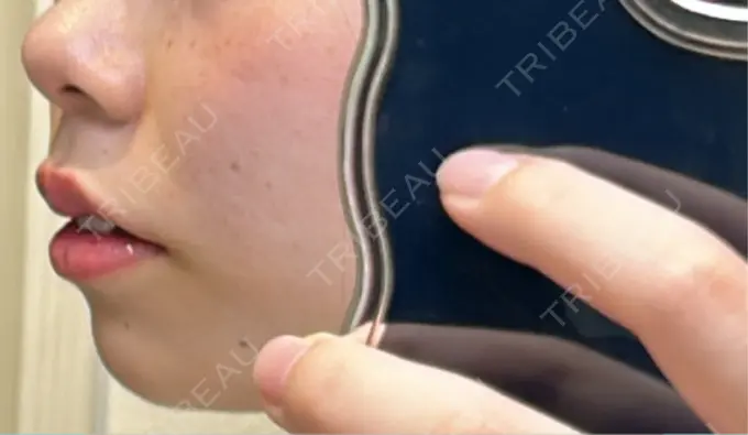 ボトックス（あご） / ヒアルロン酸注入（あご） / ヒアルロン酸注入（唇） 仙台TAクリニック DAY 1 メイン用