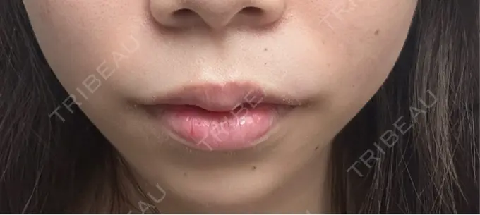 ボトックス（あご） / ヒアルロン酸注入（あご） / ヒアルロン酸注入（唇） 仙台TAクリニック DAY 3 メイン用