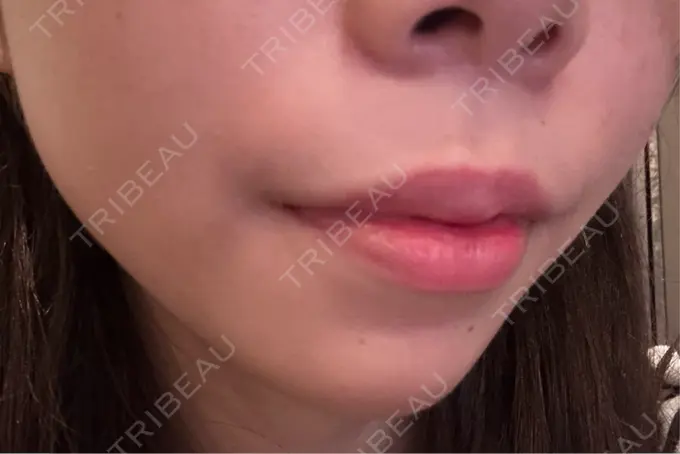 ボトックス（あご） / ヒアルロン酸注入（あご） / ヒアルロン酸注入（唇） 仙台TAクリニック DAY 11 メイン用