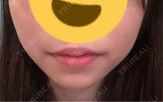 ボトックス（あご） / ヒアルロン酸注入（あご） / ヒアルロン酸注入（唇） 仙台TAクリニック AFTER メイン用