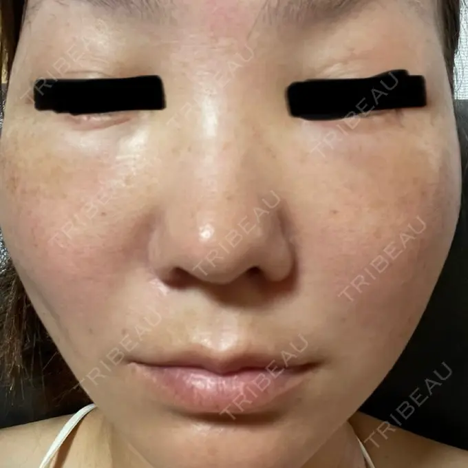 糸リフト / クマ治療 / 肌ヒアルロン酸注入（たるみ・シワ改善） ルラ美容クリニック 静岡院 DAY 2 メイン用