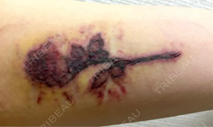 タトゥー除去 ルラ美容クリニック 福岡本院 DAY 2 メイン用