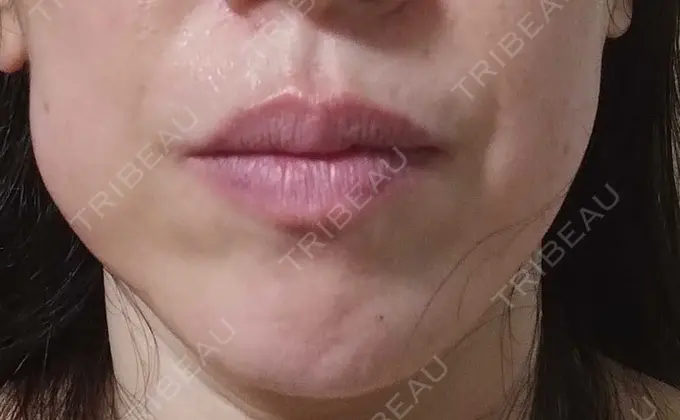 ボトックス（エラ・小顔） TCB東京中央美容外科 金山院 DAY 36 メイン用