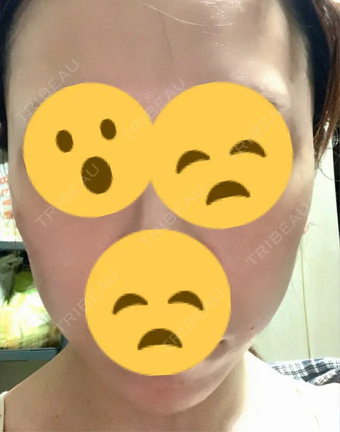 ボトックス（エラ・小顔） 東京形成美容外科 船橋院 DAY 21 メイン用