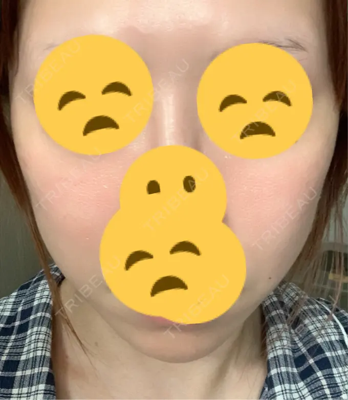 ボトックス（エラ・小顔） 東京形成美容外科 船橋院 DAY 20 メイン用