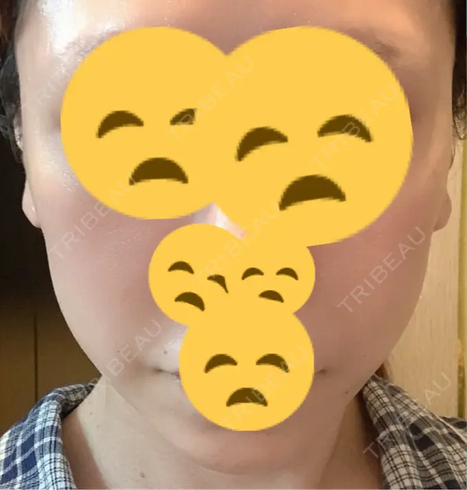 ボトックス（エラ・小顔） 東京形成美容外科 船橋院 DAY 18 メイン用