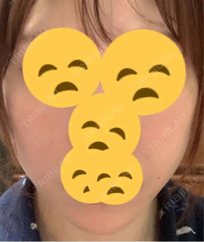 ボトックス（エラ・小顔） 東京形成美容外科 船橋院 DAY 16 メイン用