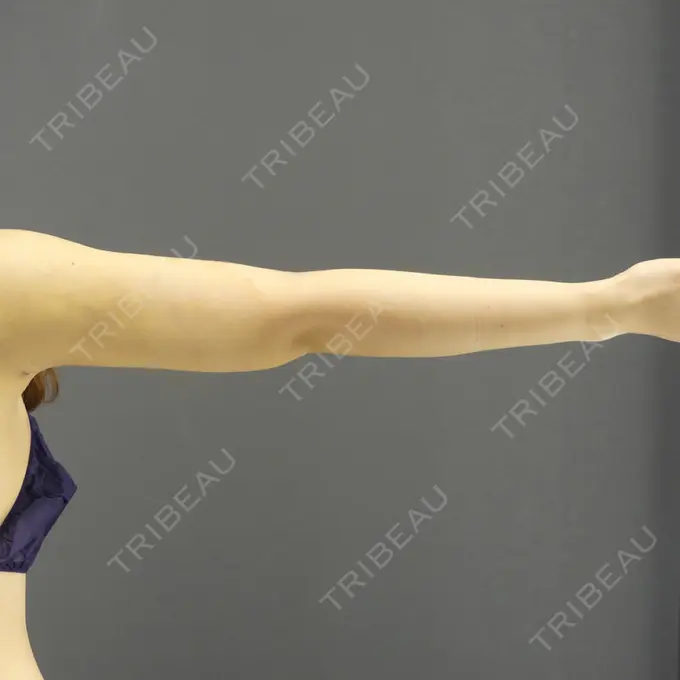 脂肪吸引（二の腕） / 脂肪吸引（肩） GRACIA clinic 【グラシアクリニック】 DAY 11 メイン用