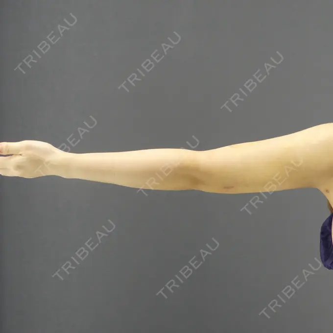 脂肪吸引（二の腕） / 脂肪吸引（肩） GRACIA clinic 【グラシアクリニック】 DAY 11 メイン用