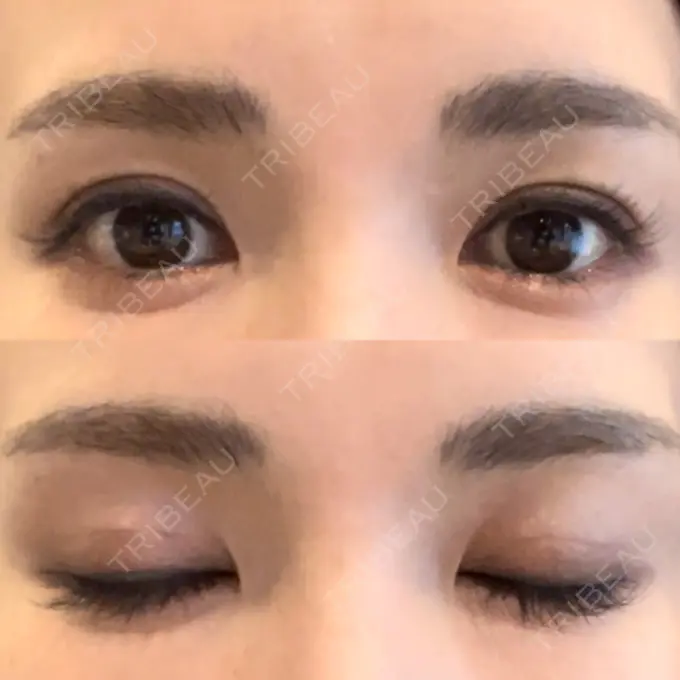 二重埋没 吉祥寺アイビークリニック AFTER メイン用