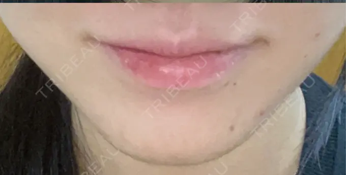 ヒアルロン酸注入（唇） / ボトックス（口角） フィラークリニック 町田院 DAY 0 メイン用